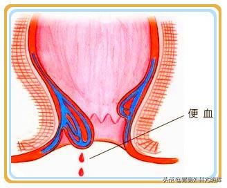 肠癌最新治疗方法，探索前沿，点燃希望之光