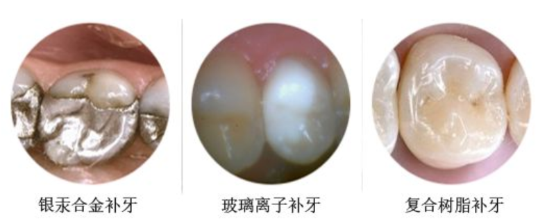 最新补牙材料革新，重塑牙齿修复未来